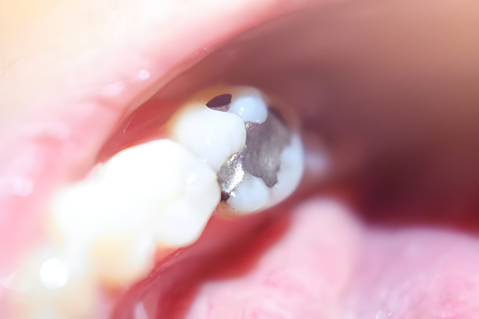 A Closer Look at the Amalgam Filling Procedure at Your Trusted Dentist in Huntingburg_FI